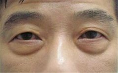 男人眼袋有痣代表的意义