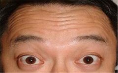 额头纹面相，各种额头纹的面相分析
