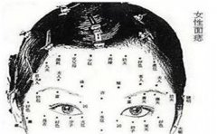 三种罕见痣相注定命中贵人多，注定发财