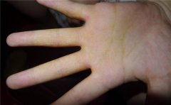 手相看健康，你的手相提示了身体状况如何