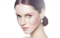 女人臉上哪些痣不能點 這6種痣不要點 不然就把福氣點沒了