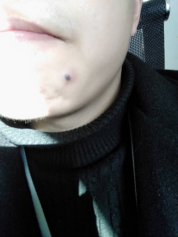 黑色痣和黑色瘤的区别 黑色痣和黑色瘤的区别图片